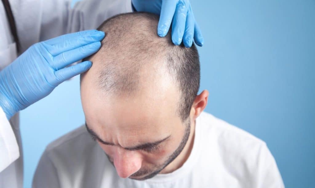 Man die een haartransplantatie ondergaat in Albanië voor natuurlijke, betaalbare haartransplantatie.