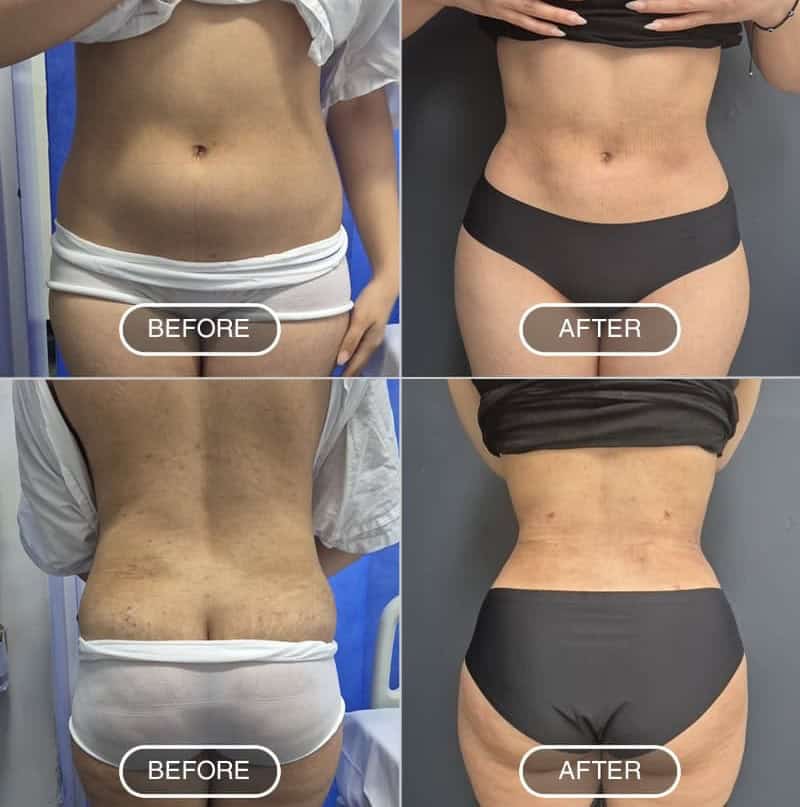 Liposuccion en Albanie