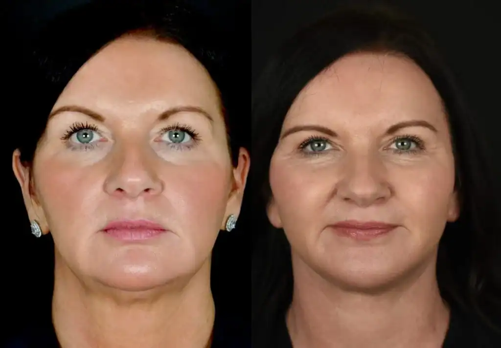 Deep Plane Facelift for Youthful Appearance.