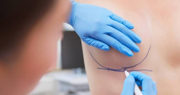 Χειρουργός σημαδεύει ασθενή για υβριδική επέμβαση αύξησης μαστών στην Αλβανία.