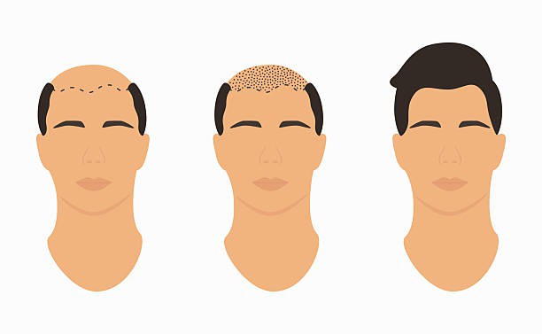 Haartransplantation in Albanien.