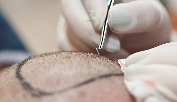 Nahaufnahme einer Haartransplantation in Albanien, die medizinische Tourismusdienstleistungen präsentiert.