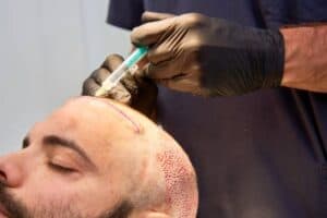 Arzt führt Haartransplantation bei Patient mit Lokalanästhesie in Albanien durch.