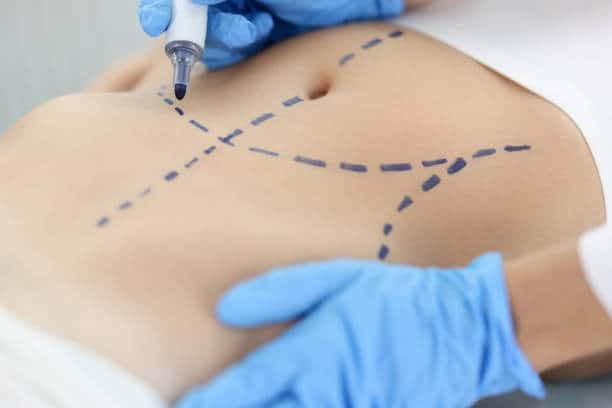 Medical procedure with marked incision lines on patient's abdomen in Albania.