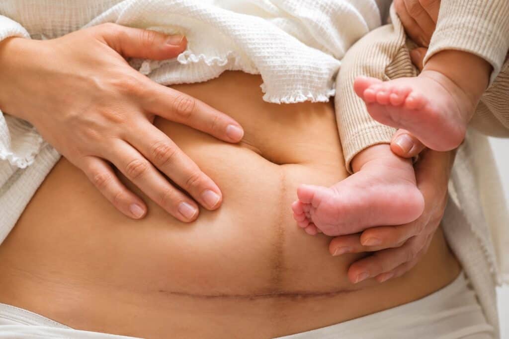 Post-C-section scar and baby on mother's abdomen in Albania.