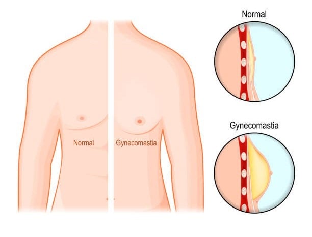 Comparison of normal breast and breast with gynecomastia.