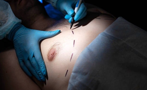 Breast surgery being performed in a medical facility with sterile gloves and surgical tools.