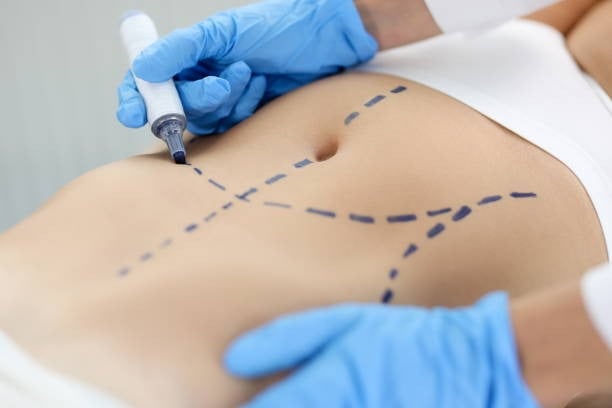 Laparoscopic surgery on a patient's abdomen with marked incision lines.