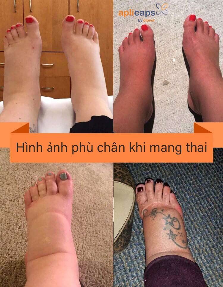 hình ảnh phù chân khi mang thai 1