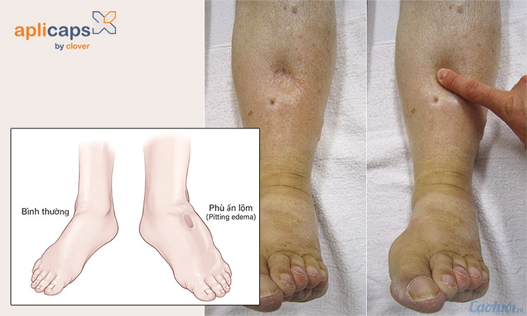 dấu hiệu phù chân khi mang thai