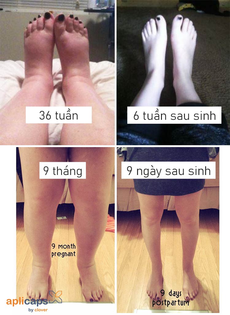 bà bầu bị phù chân tháng cuối
