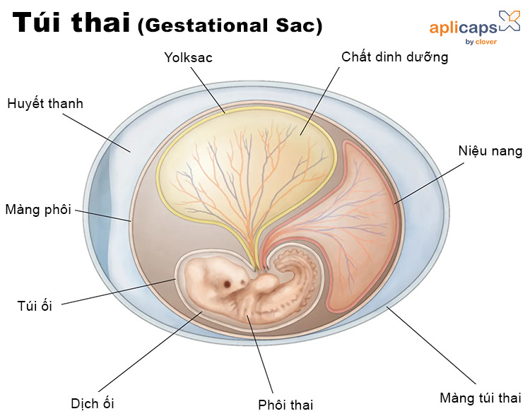 hình ảnh túi thai gestational sac