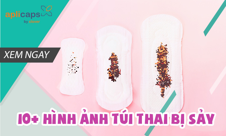 hình ảnh túi thai bị sảy