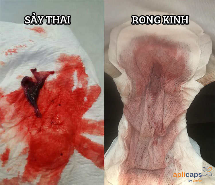 phân biệt hình ảnh túi thai 5 tuần bị sảy với rong kinh