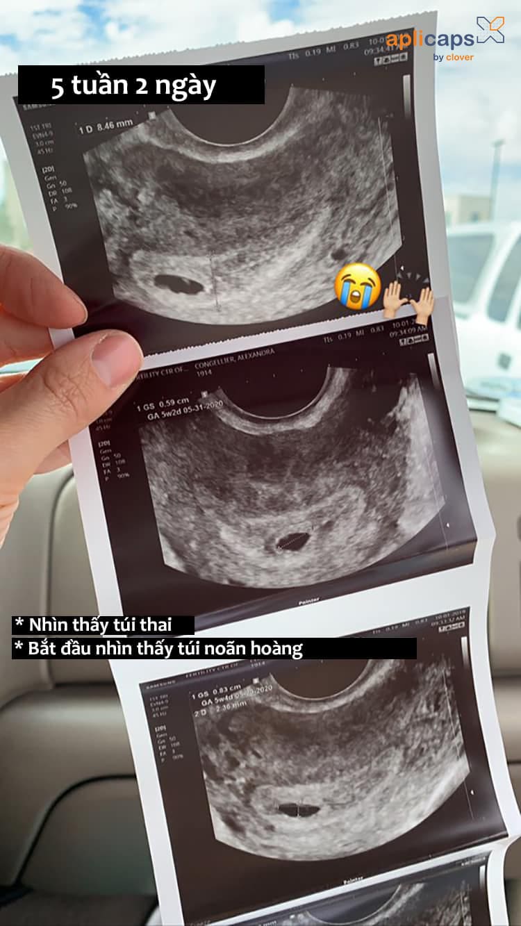 hình ảnh túi thai 5 tuần 2 ngày
