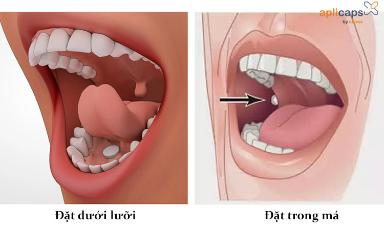 Cách ngậm thuốc đẩy thai ra ngoài