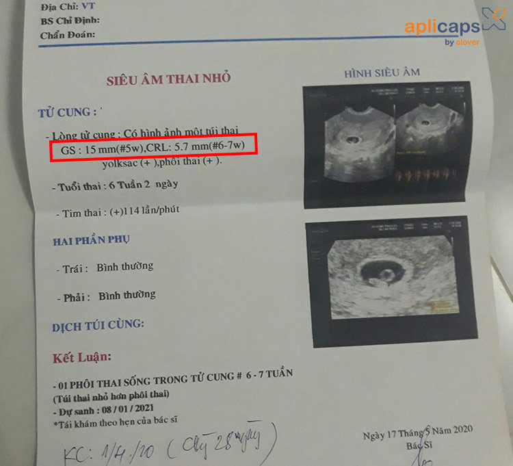 ảnh crl trong siêu âm thai