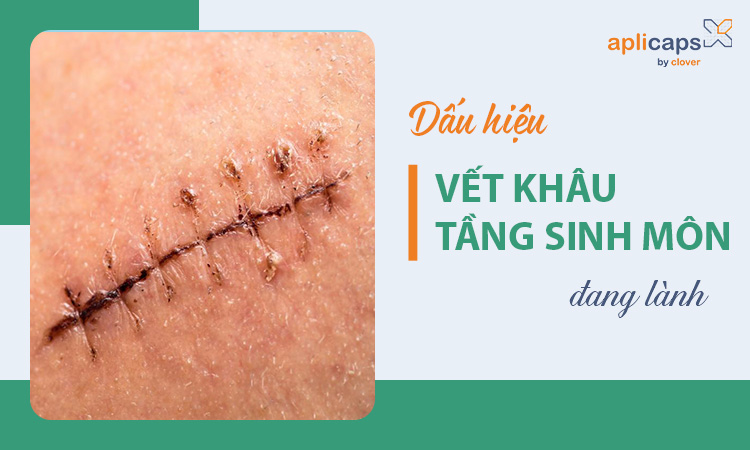 Dấu hiệu vết khâu tầng sinh môn đang lành
