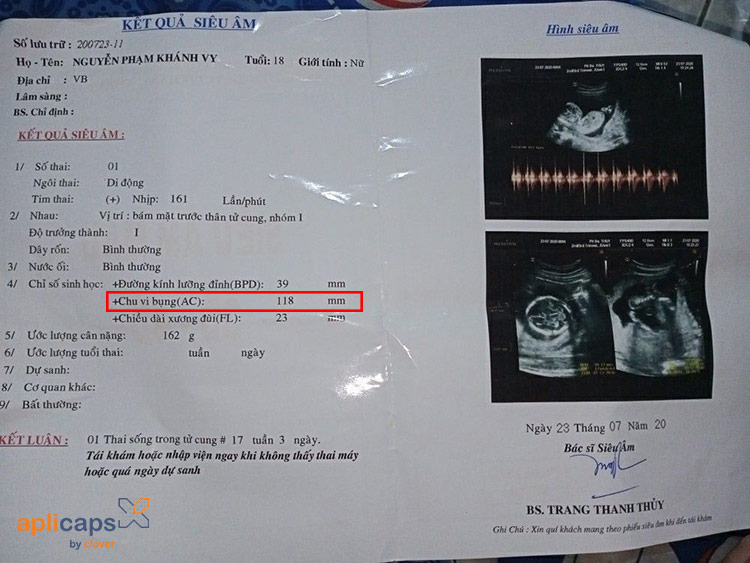 Giấy siêu âm chu vi vòng bụng thai nhi 17 tuần