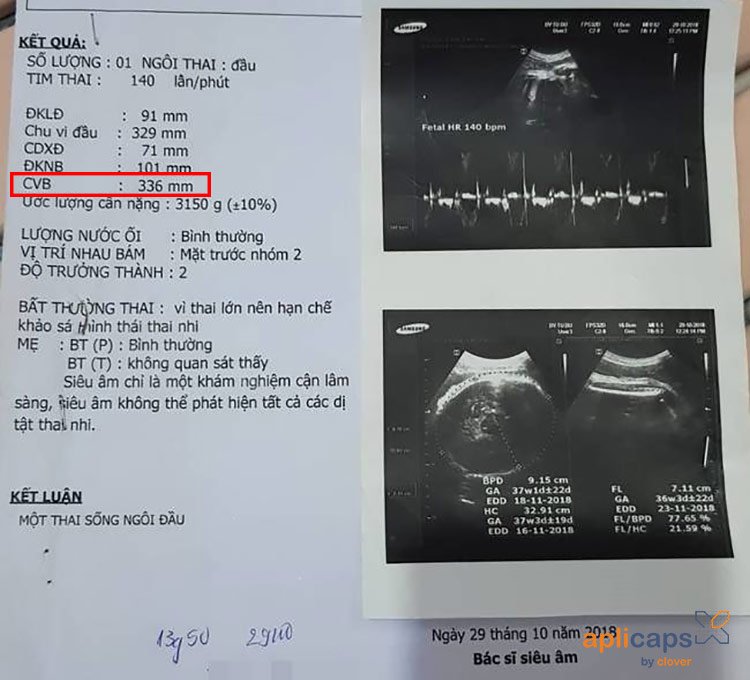 Giấy siêu âm chu vi vòng bụng thai nhi