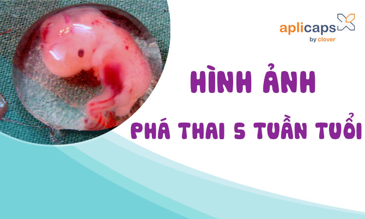hinh-anh-pha-thai-5-tuan-tuoi