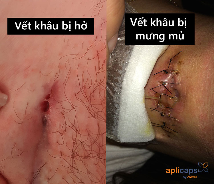hình ảnh vết khâu tầng sinh môn bị hở và mưng mủ