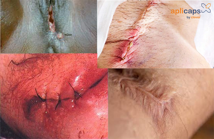 Bị đứt chỉ vết khâu tầng sinh môn có sao không