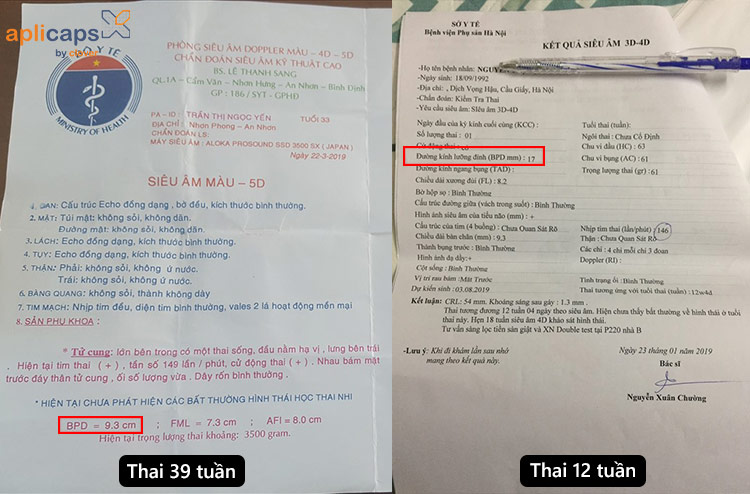 chỉ số đường kính lưỡng đỉnh theo tuần thai