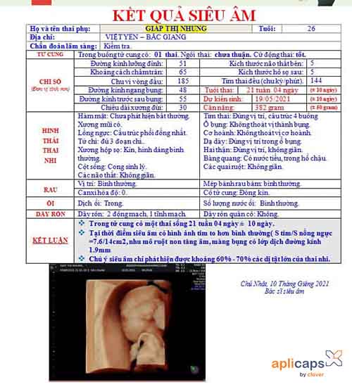 Giấy siêu âm 21 tuần