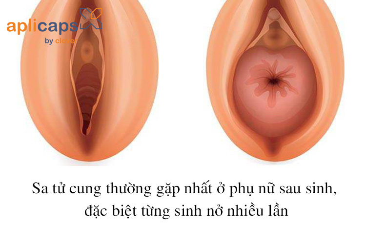 sa-tu-cung-thuong-gap-o-phu-nu-sau-sinh