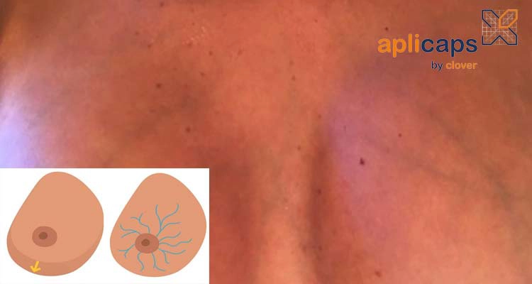 Tĩnh mạch ở ngực nổi lên(gân xanh) bà bầu không cần quá lo lắng
