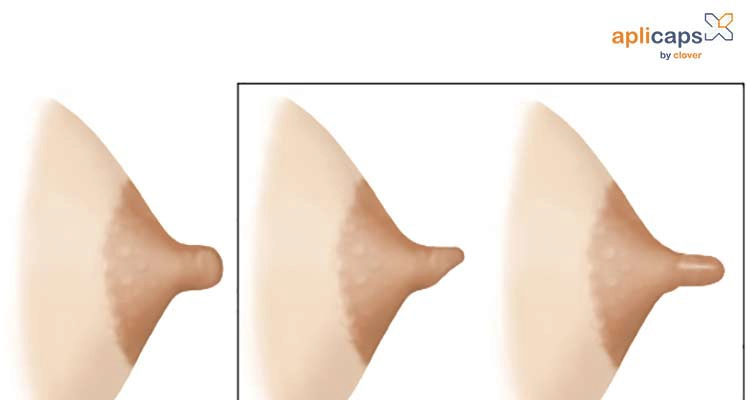 Hình ảnh ngực thay đổi sau sinh