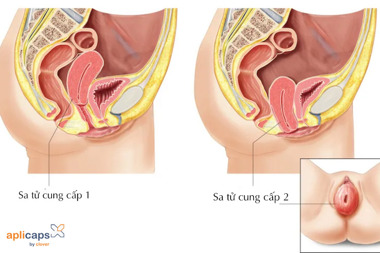 Hình ảnh cục thịt thừa ở vùng kín sau sinh sa xuống cấp độ 1