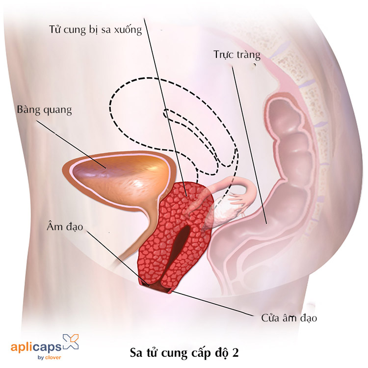 Tử cung đã tụt xuống gần cửa âm đạo