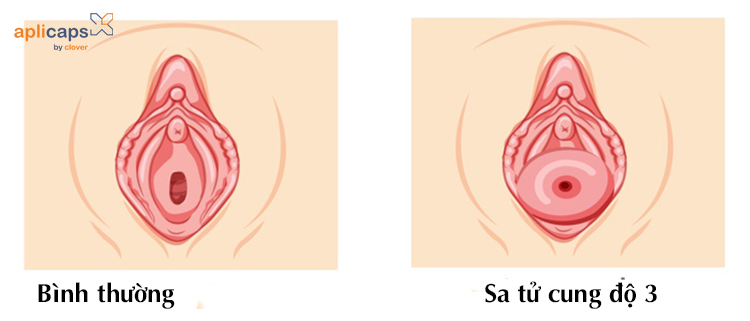 Một phần tử cung bị lồi ra khỏi cửa âm đạo