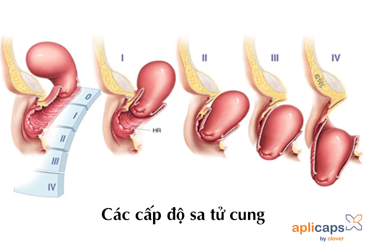 Hình ảnh cục thịt thừa ở vùng kín sau sinh các cấp độ