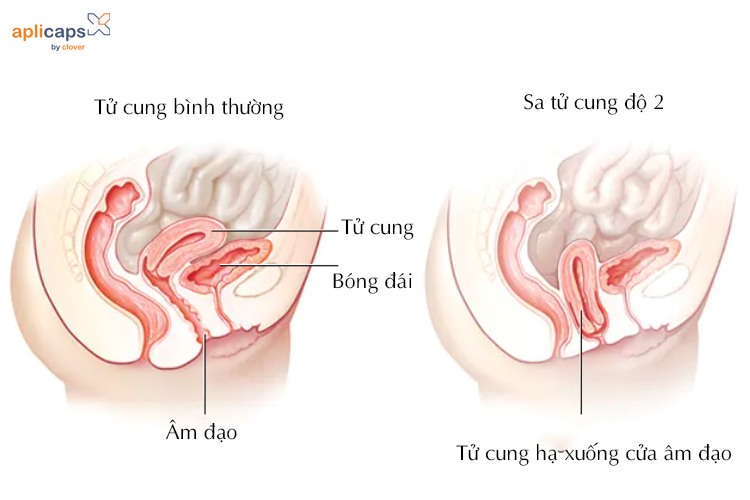Sa tử cung cấp độ 2