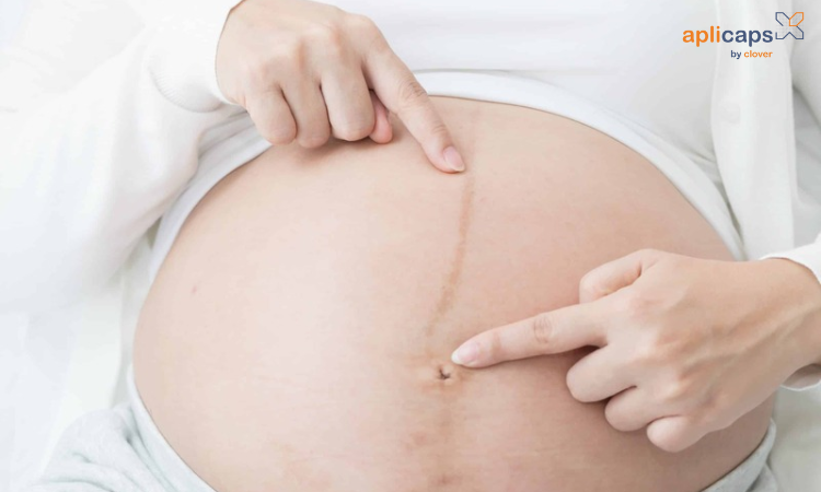 mẹ bầu có đường lông nigra kéo dài đến rốn thường mang thai bé gái