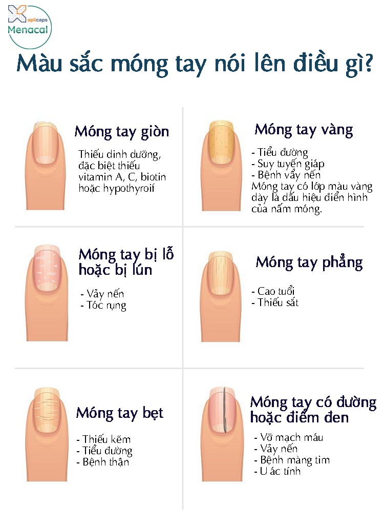 Một số vấn đề ở móng tay khác thường gặp
