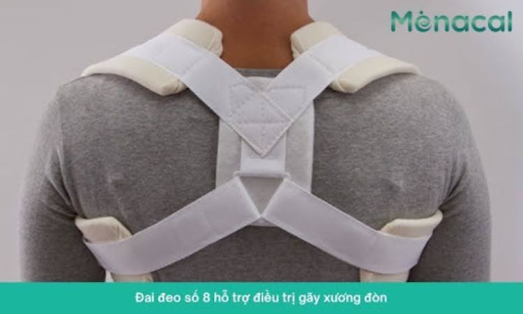 Sử dụng đai đeo số 8 là phương án điều trị gãy xương đòn phổ biến nhất.