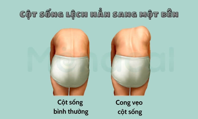 Hình ảnh minh họa cột sống lệch hẳn sang một bên