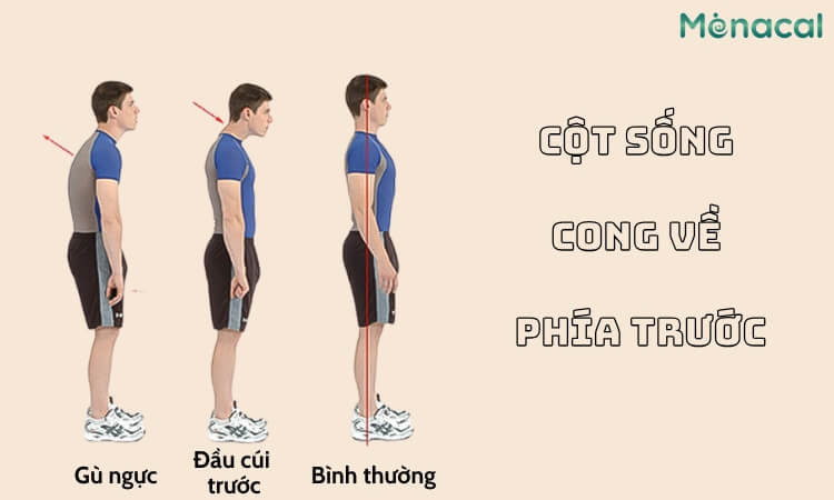 Hình ảnh của cột sống cong về phía trước ở người bị cong cột sống