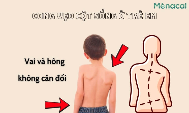 Vai và hông không cân đối do cong vẹo cột sống