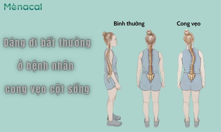 Cong vẹo cột sống gây dáng đi bất thường