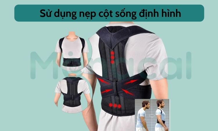 Điều trị cong vẹo cột sống bằng cách đeo đai định hình