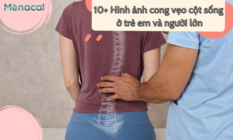 hình ảnh cong vẹo cột sống