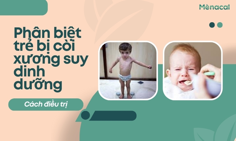 trẻ bị còi xương suy dinh dưỡng