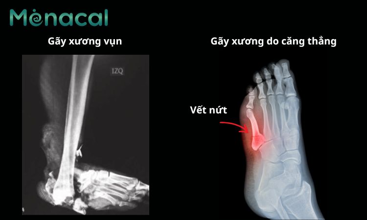 Hình ảnh gãy xương bàn chân phức tạp