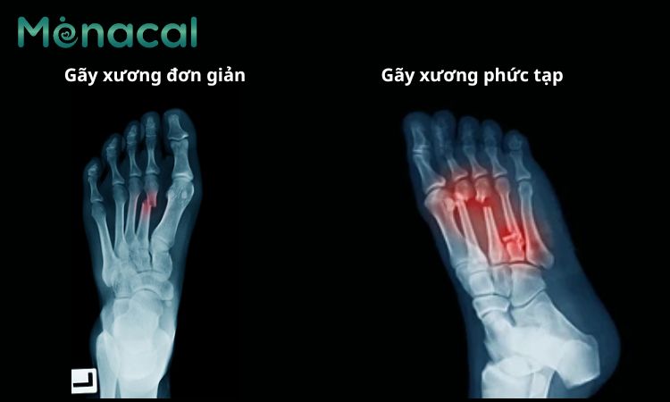 Hình ảnh xương bàn chân bị gãy qua X quang