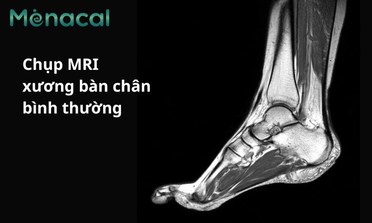 Hình ảnh xương bàn chân bình thường qua chụp MRI